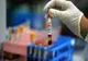 Cancerul mamar ar putea fi depistat cu un simplu test de sânge, cu cinci ani înaintea primelor simptome!