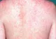 Toată lumea se teme de coronavirus, dar o altă boală face victime! În România au murit deja 64 de persoane