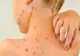 În plină epidemie de coronavirus, rujeola contină și ea să facă victime